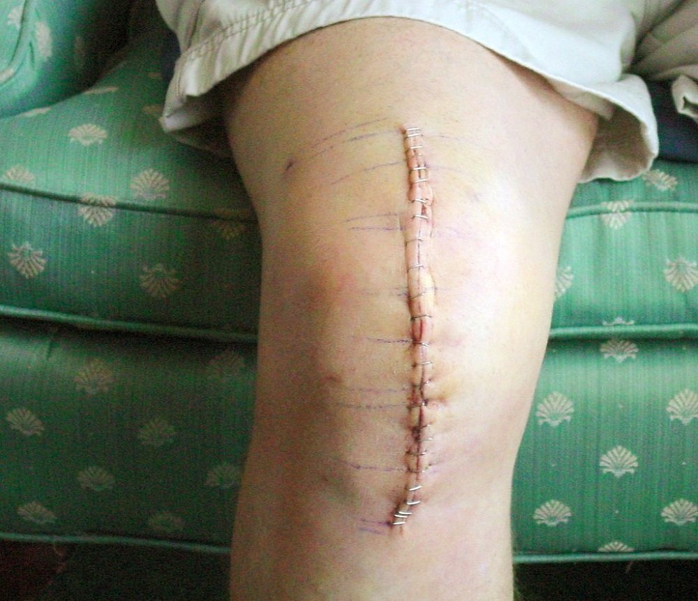 knee after knee replacement surgert